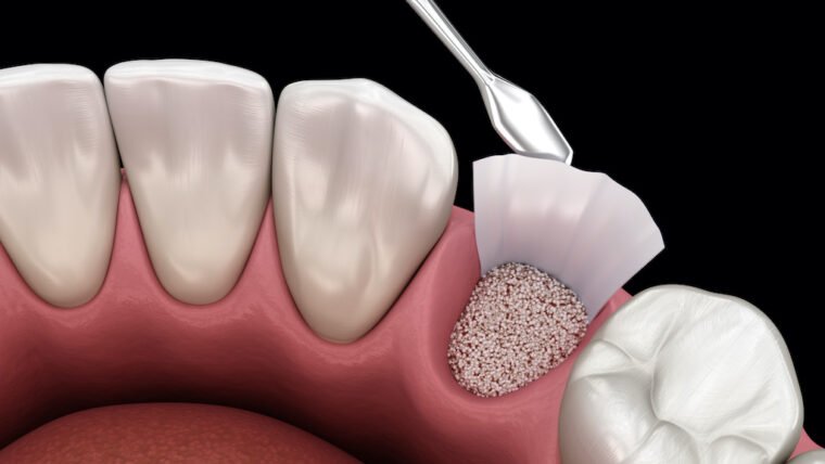 Dental implants before and after