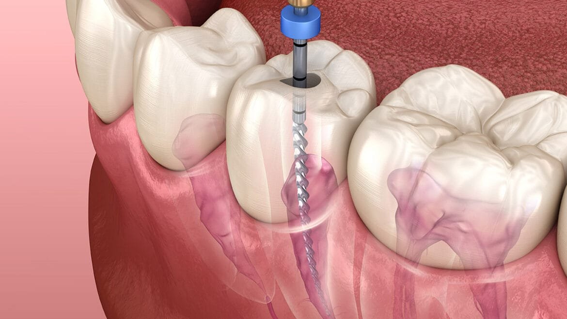 Root Canal Therapy