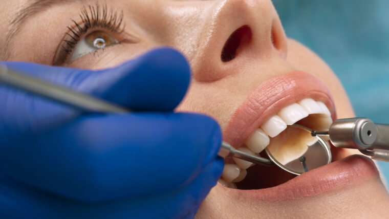 Dental Filling Services