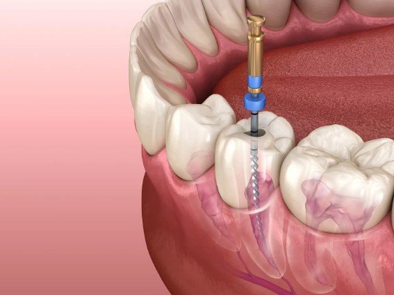 Perfect Smile Design Wellesley Toronto. How Long Does It Take for a Root Canal?