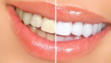 Canada Dental Care Plan Accepted. How Long Does Teeth Whitening Last?