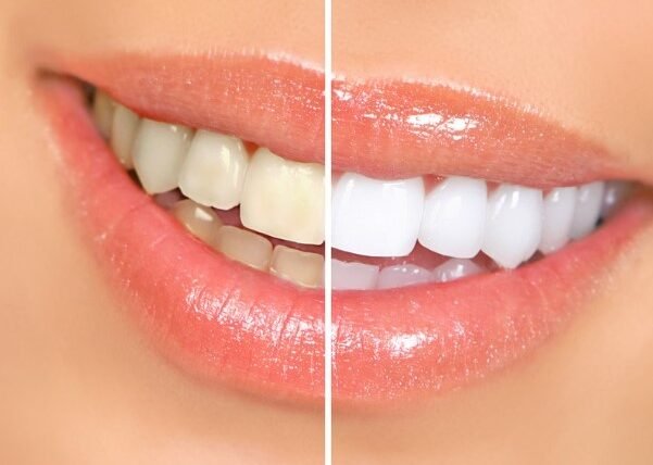 Canada Dental Care Plan Accepted. How Long Does Teeth Whitening Last?