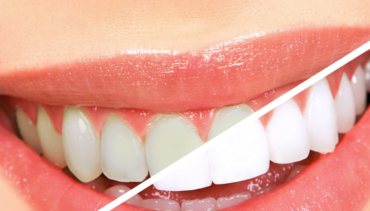 How long does teeth whitening last?