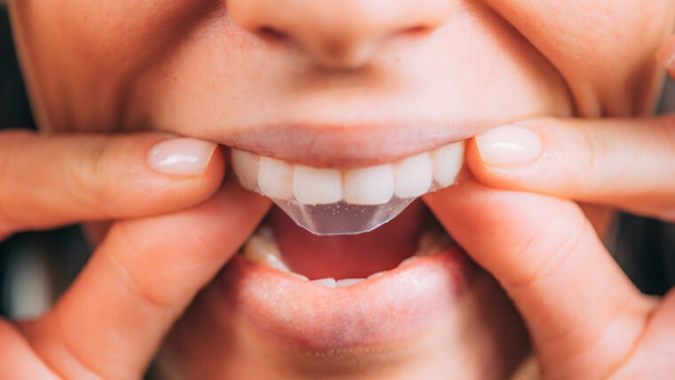 Should I Brush My Teeth Before Using Whitening Strips?