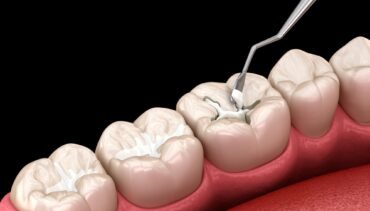 Can I eat after a dental filling?