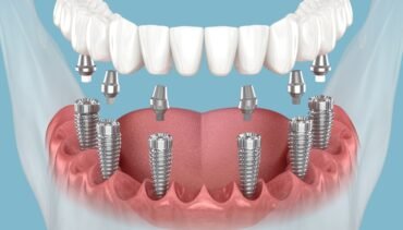 Full Mouth Dental Implants