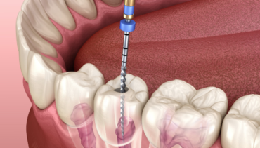 How do I know if i need a root canal?