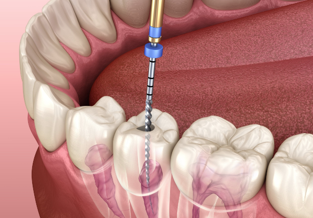 How do I know if i need a root canal?