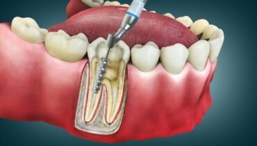 How Long Does A Root Canal Last Without A Crown?