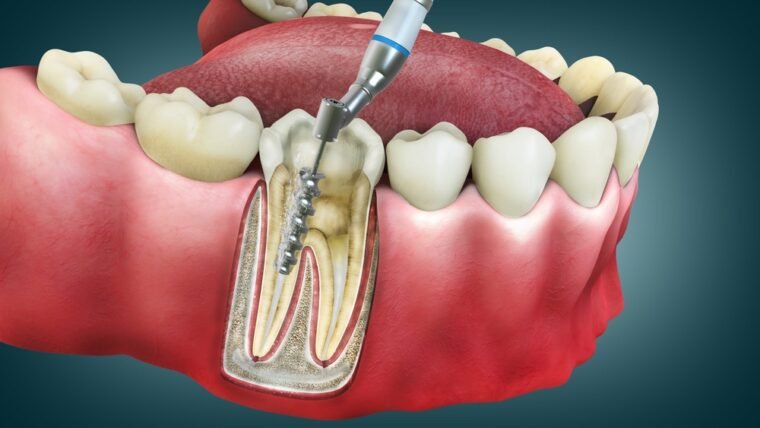 How Long Does A Root Canal Last Without A Crown?