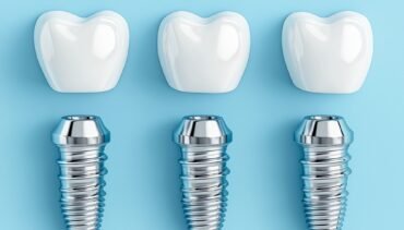 Does ODSP Cover Dental Implants