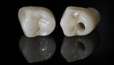 Dental Crown vs Veneer