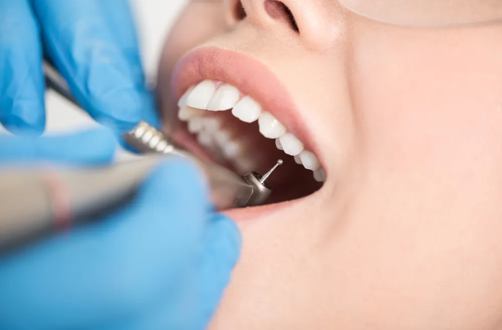 How Long Does Dental Filling Last