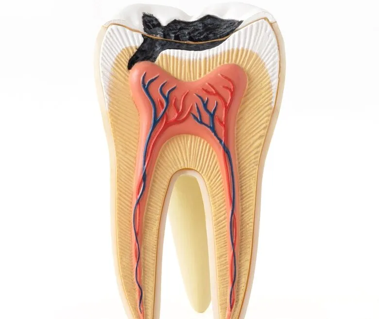 Root Canal Recovery Time