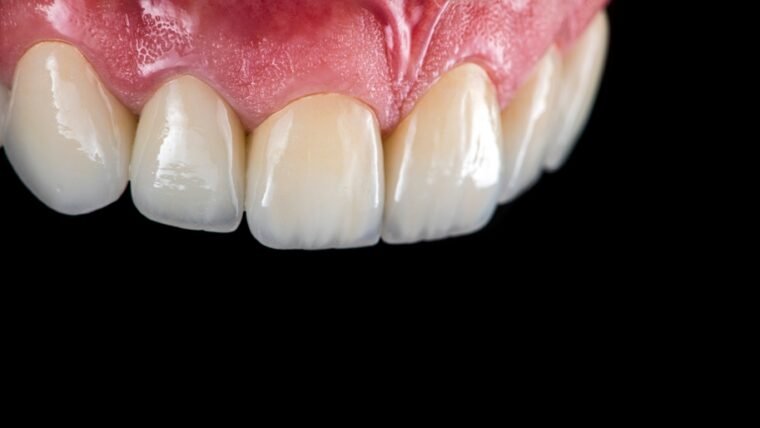 Upper Denture Implants