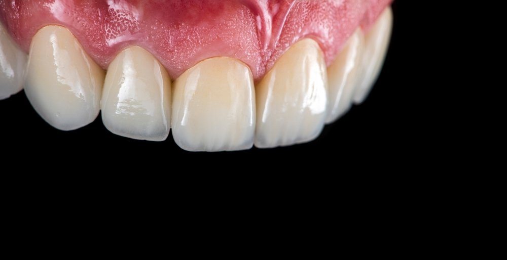 Upper Denture Implants